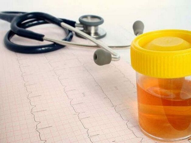 urīna analīze, lai diagnosticētu cistītu